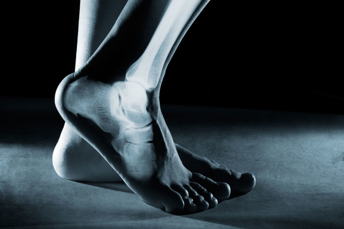 Tips For Preventing Foot And Ankle Injuries Huntington Orthopedics