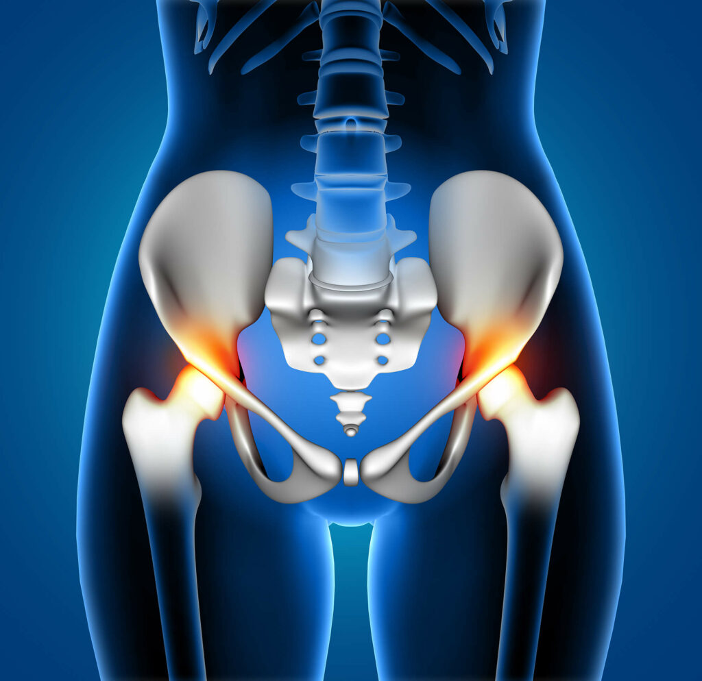 Advantages Of Anterior Hip Replacement Surgery Huntington Orthopedics